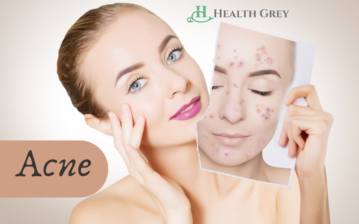 A Girl with an acne mask before and after
