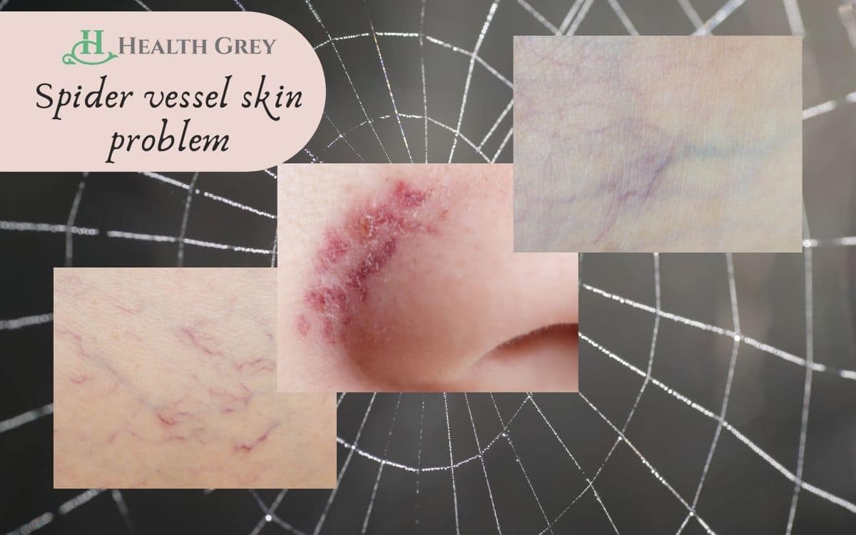 spider vessel skin problem, skin disease of the face