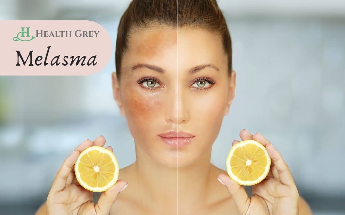 Melasma before and after picture of a girl