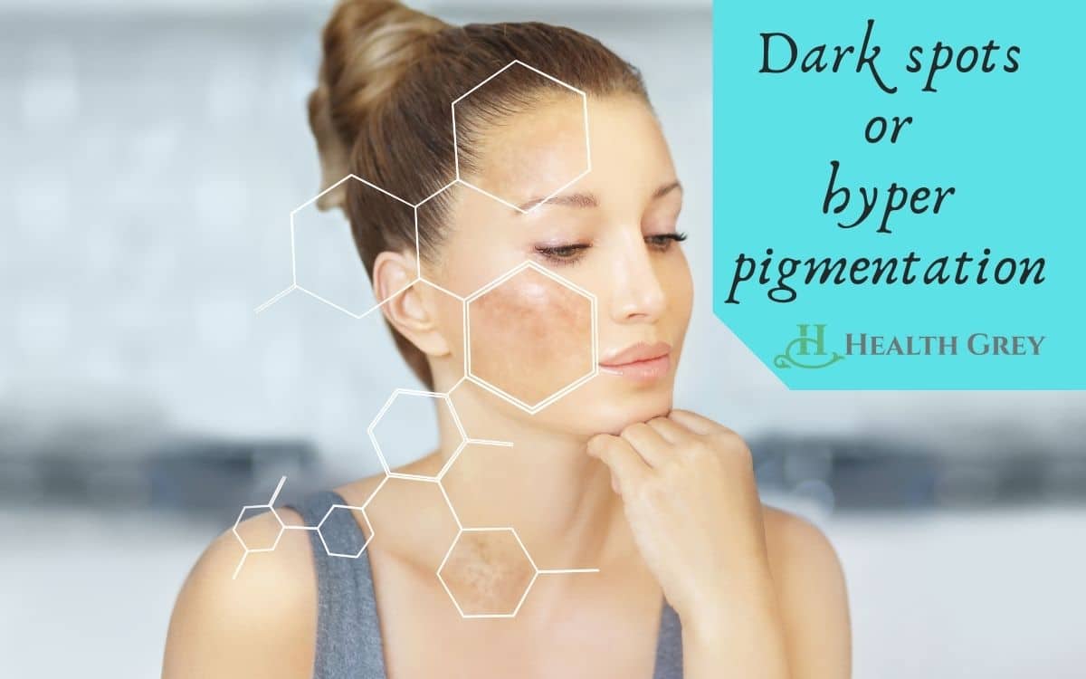 Dark spots or hyperpigmentation, different types of skin problems on face