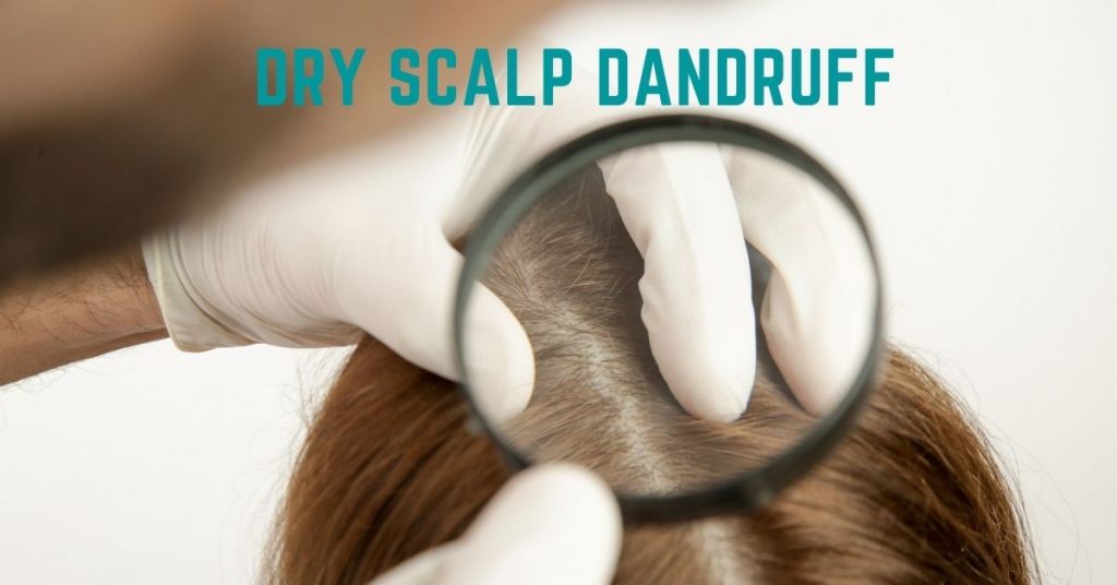 Dry Scalp Dandruff