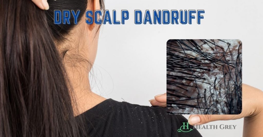 Oil Scalp Dandruff