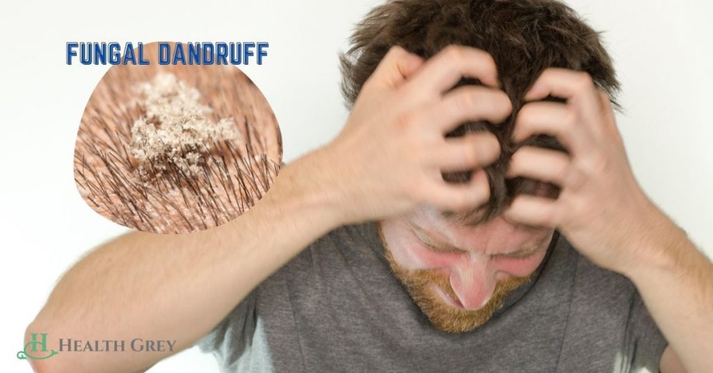 Fungal Dandruff