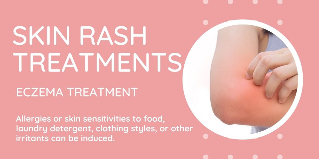 skin rash treatments eczema