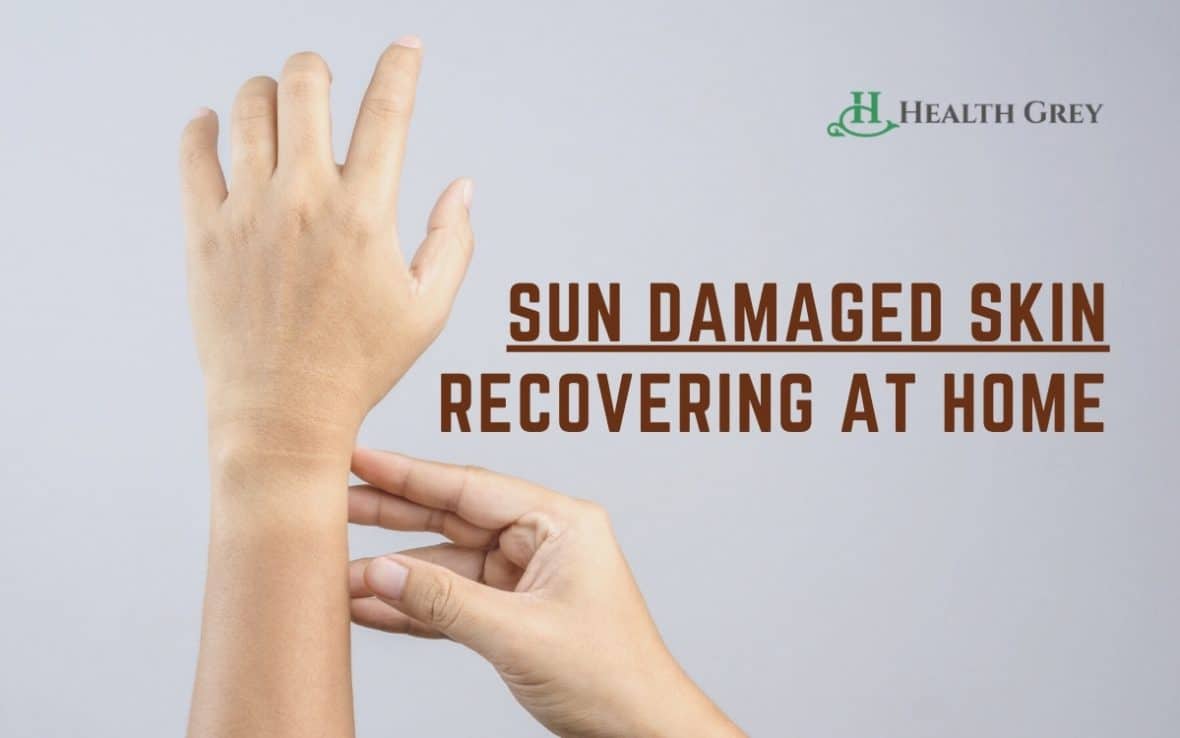 Recovering From Sun Damaged Skin At Home