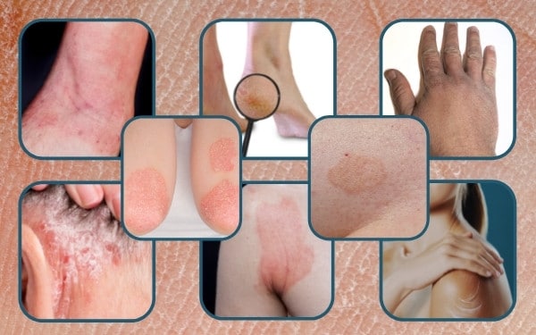 dry patch on skin occur different parts of body