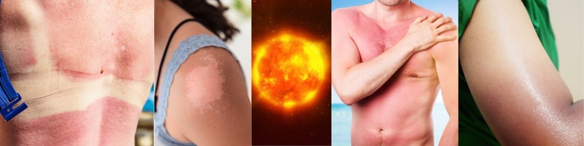 sun damaged skin