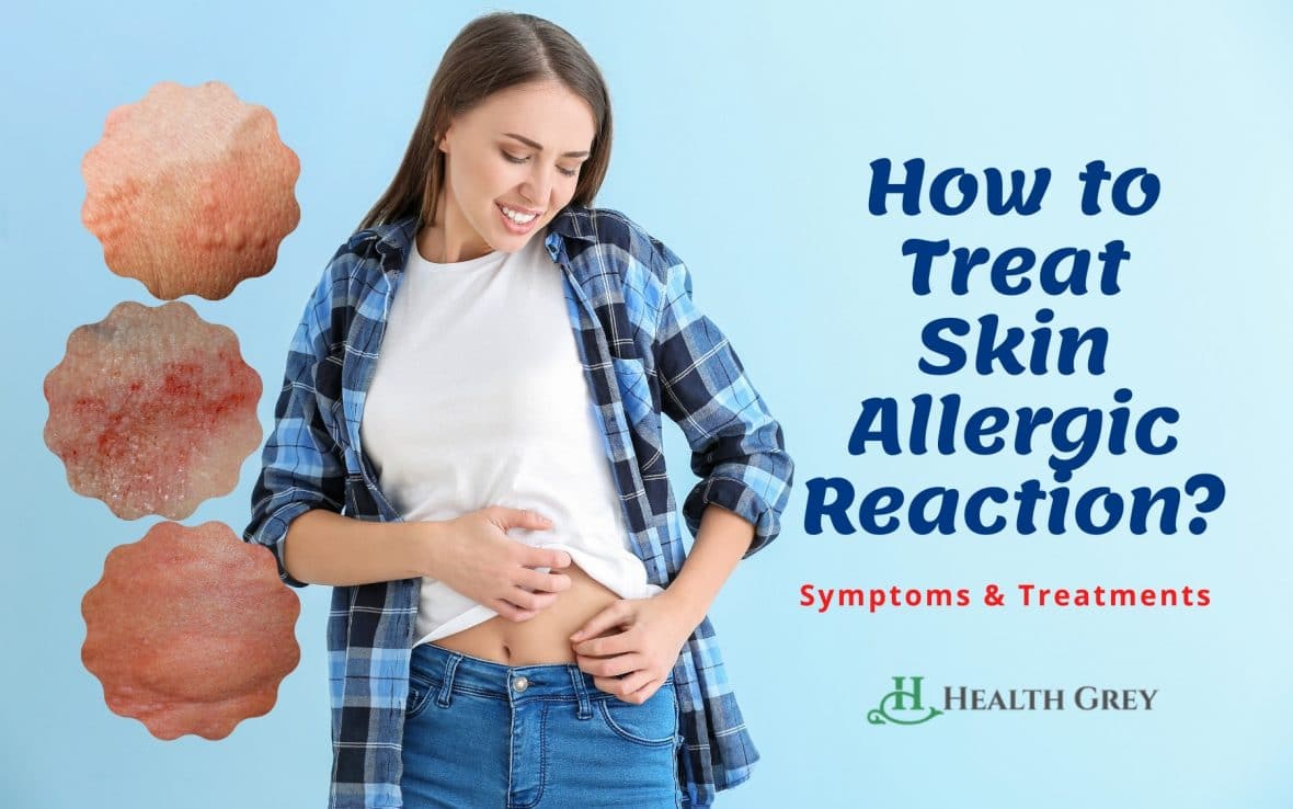 How to treat a skin allergic reaction