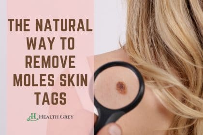 HOW TO REMOVE MOLES SKIN TAGS NATURALLY