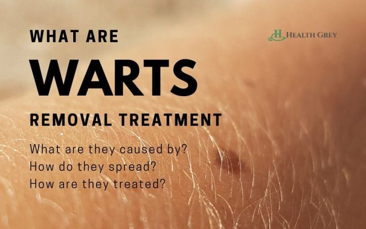 What Are Warts? The Most Common Type And Treatment Options. | Health Grey